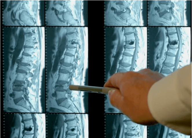 Types of osteochondrosis of the spine