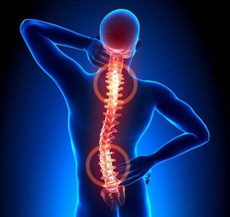 The spine osteochondrosis