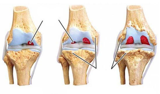 degree arthrosis