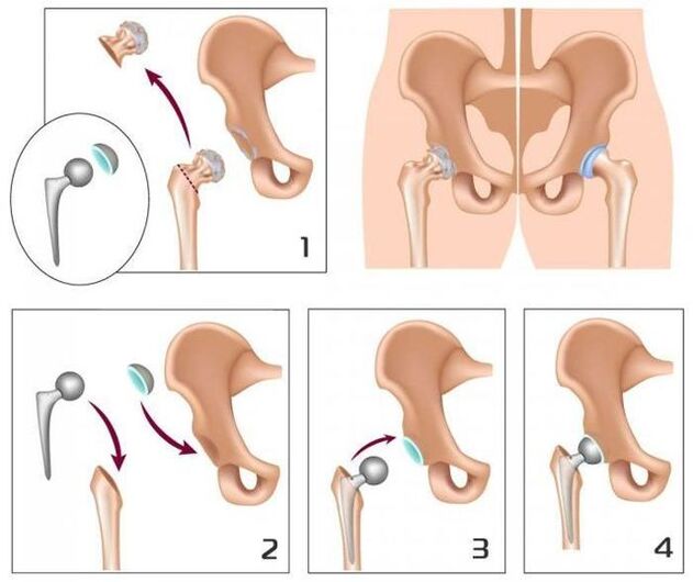 Replacing a sore joint with prosthesis