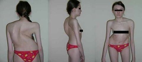 The curvature of the spine is the result of osteochondrosis