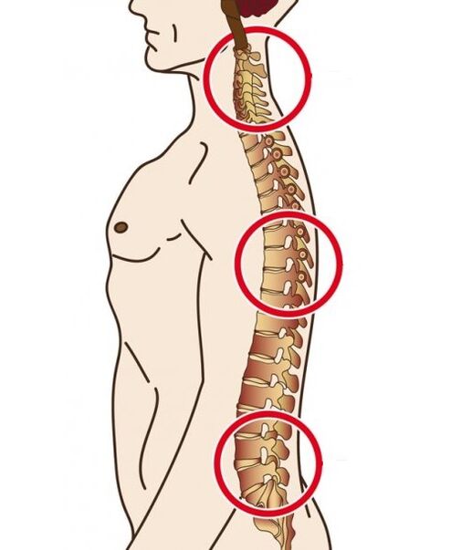 spine classes in which osteochondrosis occurs