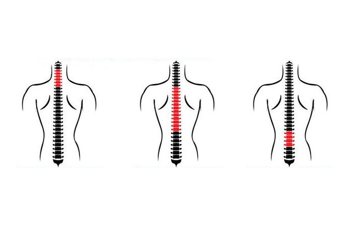 How is osteochondrosis manifested