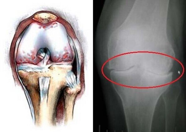 arthrosis of the knee joint