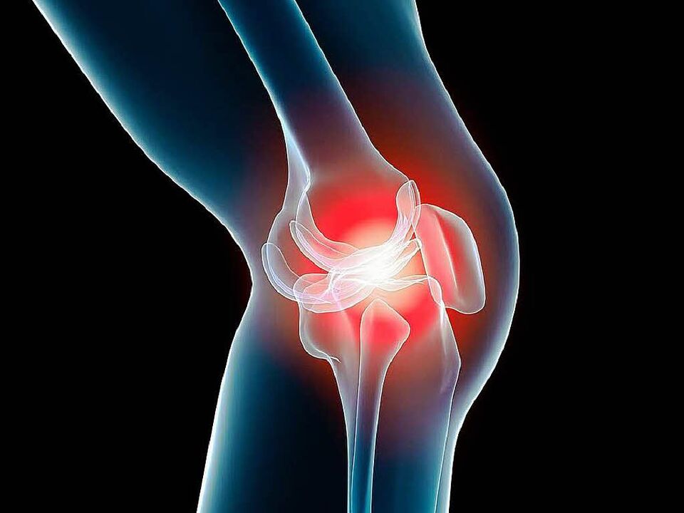 knee arthrosis