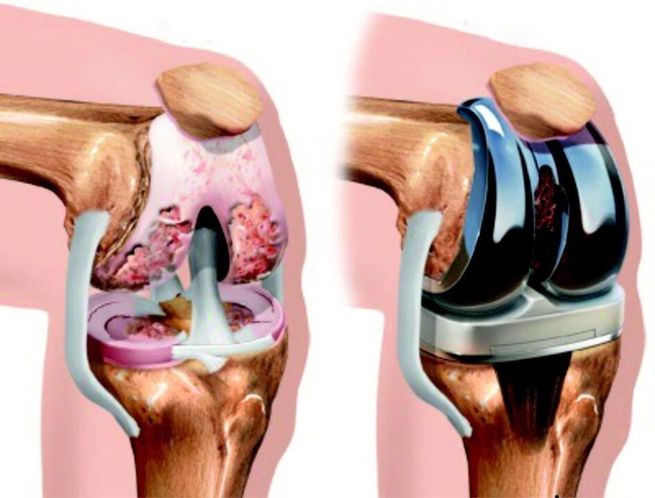 In case of complete damage of the knee joint caused by arthrosis, it can be restored with an endoprosthesis