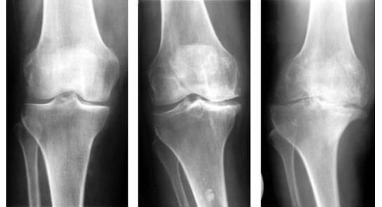When identifying arthrosis of the knee, a mandatory diagnostic measure is an X-ray